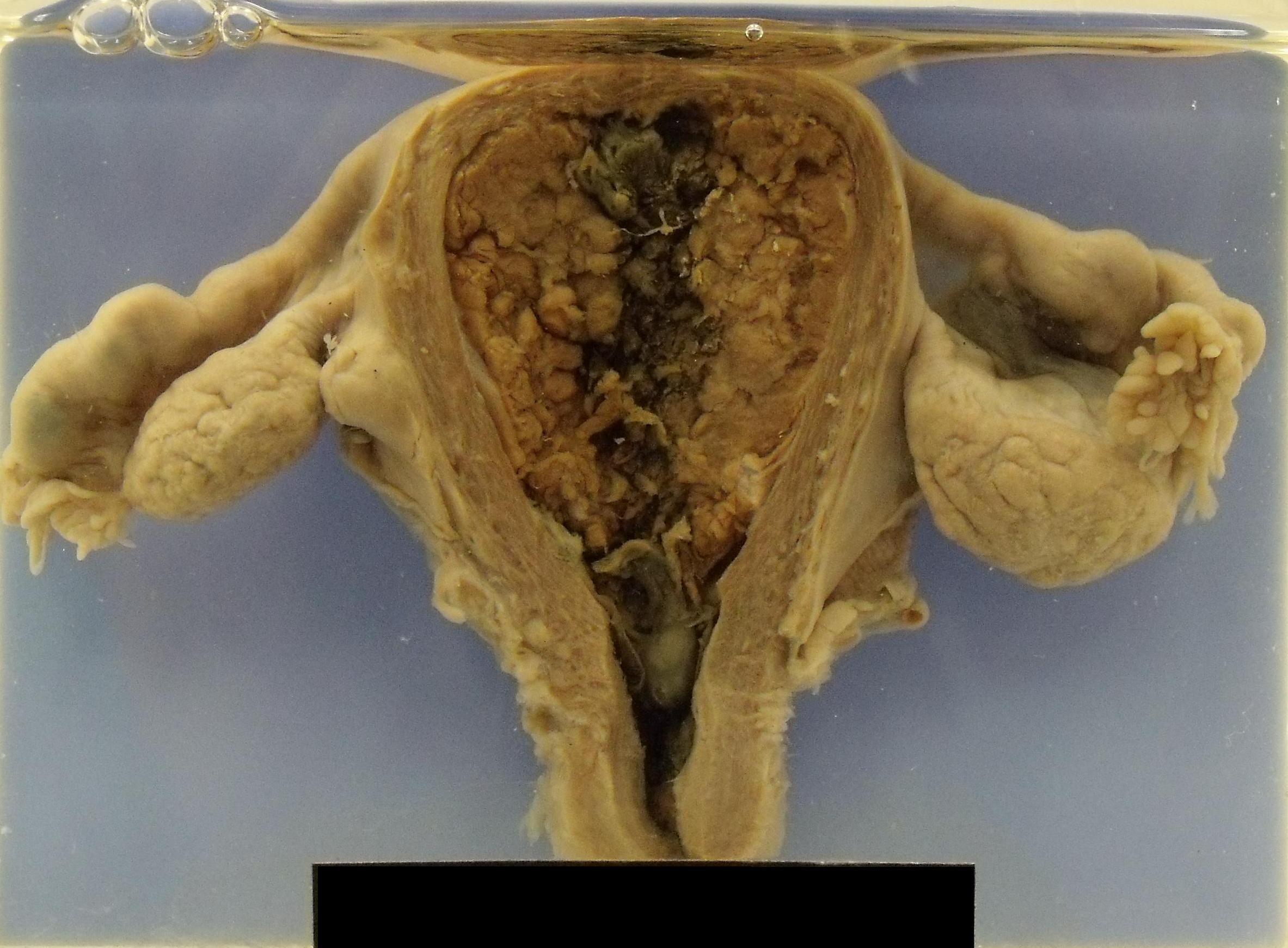 Endometrial carcinoma